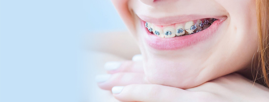 จัดฟัน Braces