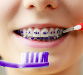จัดฟัน Braces