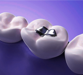 อุดฟัน Fill Teeth