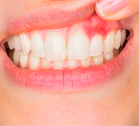 โรคเหงือก Gum Disease