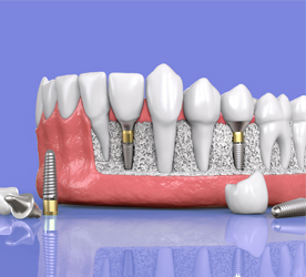 รากฟันเทียม Implants