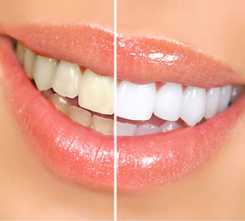 ฟอกสีฟัน teethbleaching