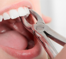 ถอนฟัน Tooth Extraction